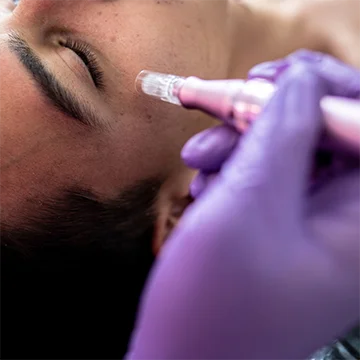 microneedling