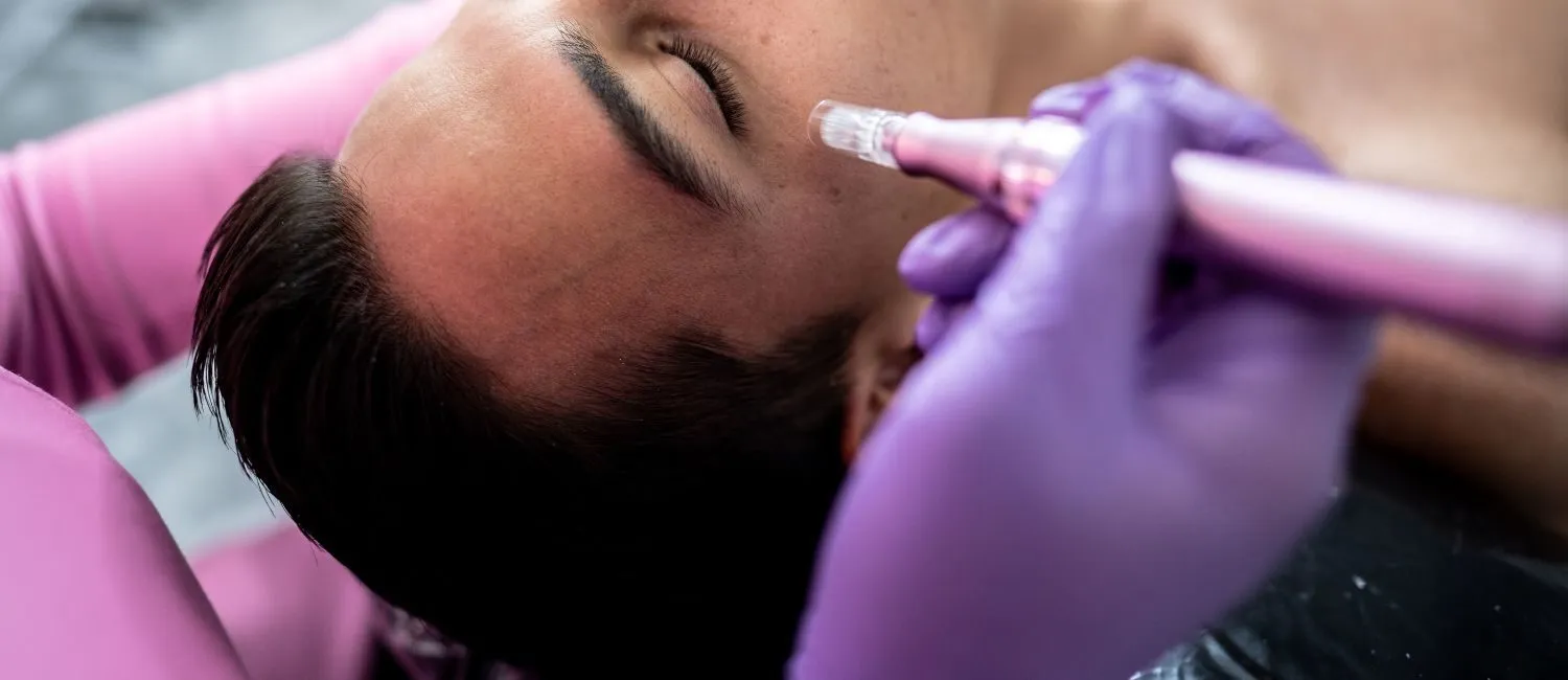 MIcroneedling.webp