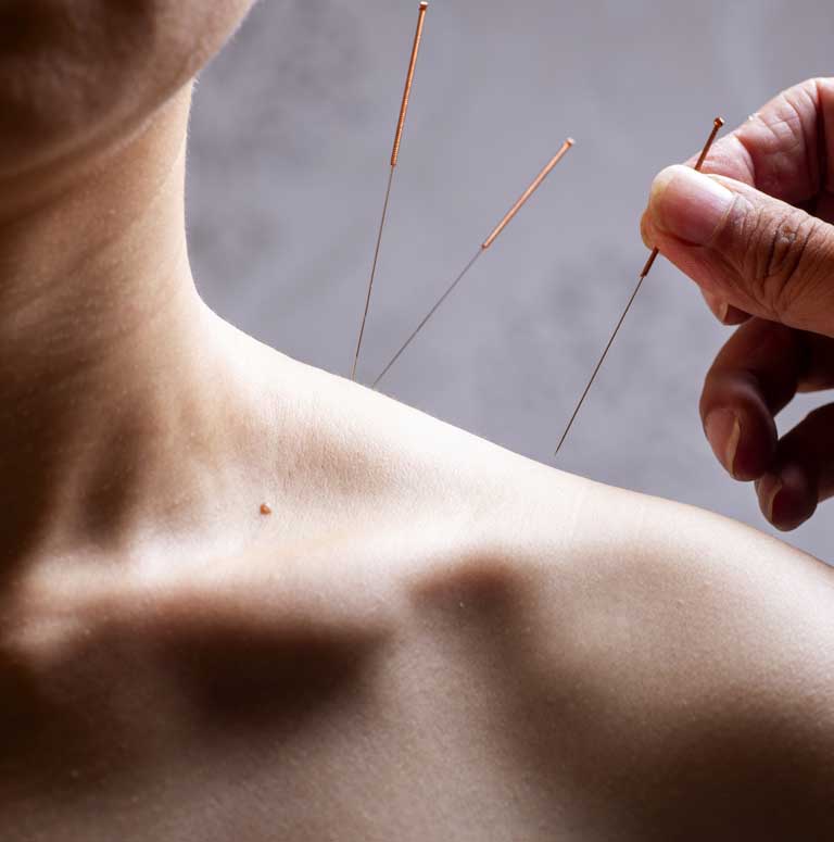 acupuncture-miami-florida-2